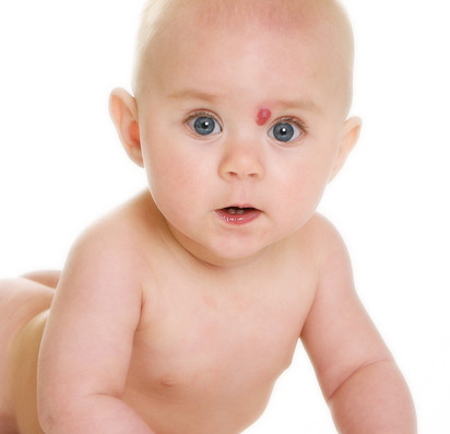 Birthmarks and baby spots
